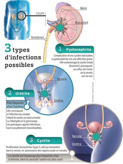 Méat urinaire : femme, homme, schéma, inflammation